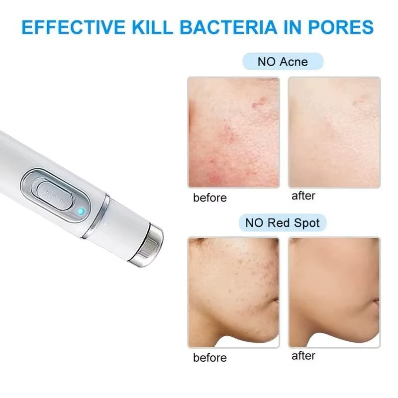 Acne Remove Blue-Light Laser Pen