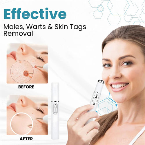 Acne Remove Blue-Light Laser Pen