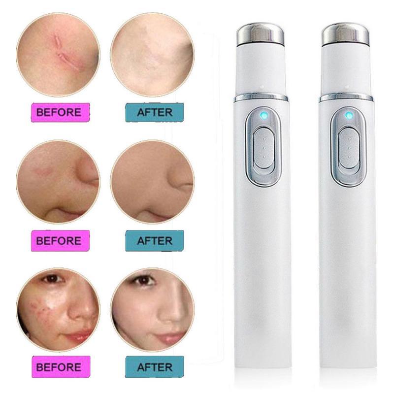 Acne Remove Blue-Light Laser Pen